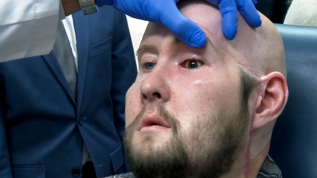 A man who received an eye and partial face transplant is examined by a doctor